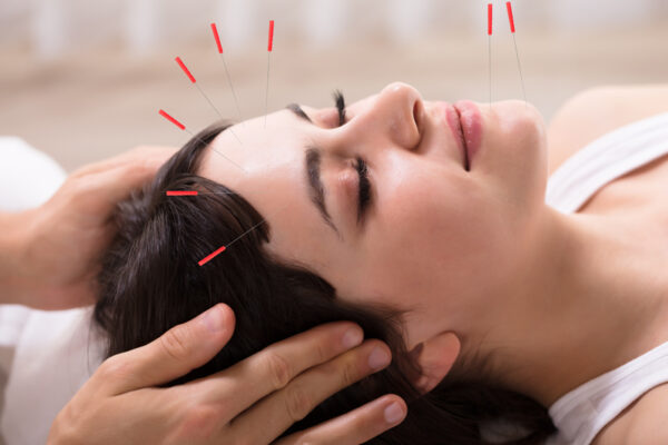 cosmetic Acupuncture Treatment cosmetic acupuncture brighton