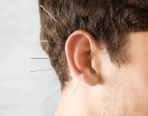 NADA ear acupuncture brighton