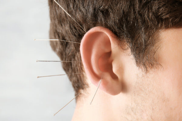 nada-ear-acupuncture-brighton NADA ear acupuncture brighton